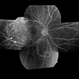 Bilateral Metastatic Lesions Secondary to Breast Cancer Bilateral Metastatic Lesions Secondary to Breast Cancer