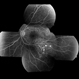 Bilateral Metastatic Lesions Secondary to Breast Cancer Bilateral Metastatic Lesions Secondary to Breast Cancer