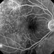 Bilateral Metastatic Lesions Secondary to Breast Cancer Bilateral Metastatic Lesions Secondary to Breast Cancer