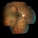 Bilateral Metastatic Lesions Secondary to Breast Cancer Bilateral Metastatic Lesions Secondary to Breast Cancer