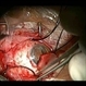 Scleral Band