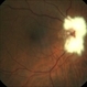 Optic Nerve Mielinization Optic Nerve Mielinization