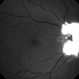 Optic Nerve Mielinization