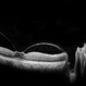 Vitreomacular Traction Vitreomacular Traction