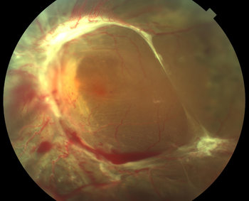 tractional retinal detachment tractional retinal detachment