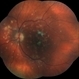 Punctate Inner Choroidopathy Complicated with CNV