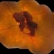 Macular Pre-Retinal Hemorrhage