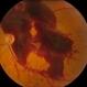 Macular Pre-Retinal Hemorrhage