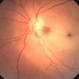 Central Retinal Artery Occlusion Central Retinal Artery Occlusion