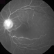 Central Retinal Artery Occlusion Central Retinal Artery Occlusion