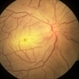 Central Retinal Artery Occlusion Central Retinal Artery Occlusion