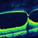 Tractional Retinal Detachment Tractional Retinal Detachment