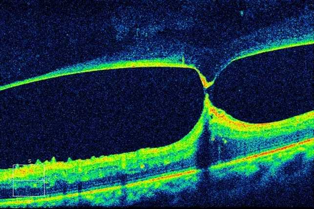 Tractional Retinal Detachment Retina Image Bank