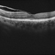 Vitreomacular Traction Vitreomacular Traction