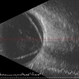 Open Funnel Retinal Detachment Open Funnel Retinal Detachment