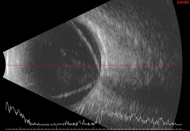 Open Funnel Retinal Detachment - Retina Image Bank