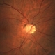 Optic disc drusen Optic disc drusen