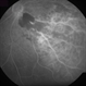 Inferonasal BRVO - Fluorescein Angiogram Inferonasal BRVO - Fluorescein Angiogram