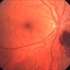 Inferonasal Branch Retinal Vein Occlusion Inferonasal Branch Retinal Vein Occlusion
