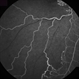 Ischemic BRVO Ischemic BRVO