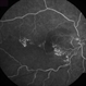 Ischemic BRVO Ischemic BRVO