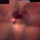 Branch Retinal Vein Occlusion with Macular Edema Branch Retinal Vein Occlusion with Macular Edema