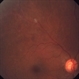 Ischemic BRVO with Neovascularization Ischemic BRVO with Neovascularization