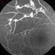 Ischemic BRVO with Neovascularization Ischemic BRVO with Neovascularization