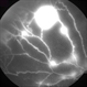 Ischemic BRVO with neovascularization Ischemic BRVO with neovascularization