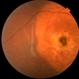 Choroidal Osteoma  + CNV Choroidal Osteoma  + CNV