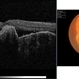 Choroidal Osteoma  + CNV Choroidal Osteoma  + CNV