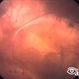 Choroidal Osteoma Choroidal Osteoma