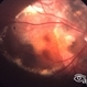 Choroidal Osteoma with Choroidal Neovascularization Choroidal Osteoma with Choroidal Neovascularization