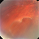 Retinoschisis Retinoschisis
