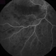 Hemicentral Retinal Vein Occlusion - Fluorescein Angiogram Hemicentral Retinal Vein Occlusion - Fluorescein Angiogram