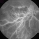 Hemicentral Retinal Vein Occlusion - Fluorescein Angiogram Hemicentral Retinal Vein Occlusion - Fluorescein Angiogram