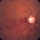 Hemicentral Retinal Vein Occlusion Hemicentral Retinal Vein Occlusion