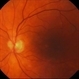 Pattern Macular Dystrophy Pattern Macular Dystrophy