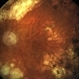 Regressed Proliferative Diabetic Retinopathy following PRP Regressed Proliferative Diabetic Retinopathy following PRP