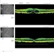 Central Serous Chorioretinopathy (CSC) Central Serous Chorioretinopathy (CSC)