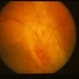 peripapillary traction RD from PDR peripapillary traction RD from PDR