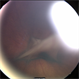 Persistent Fetal Vasculature (PFV) Persistent Fetal Vasculature (PFV)