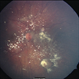Retinoblastoma with Multiple Vitreous Seeding Retinoblastoma with Multiple Vitreous Seeding