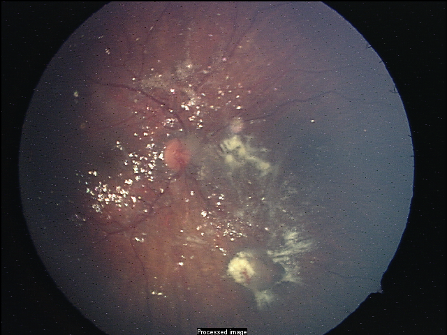 Retinoblastoma With Multiple Vitreous Seeding Retina Image Bank retinoblastoma-with-multiple-vitreous-seeding-retina-image-bank