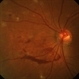 Proliferative Diabetic Retinopathy Proliferative Diabetic Retinopathy