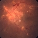 Proliferative Diabetic Retinopathy - Neovascularization on the Disc Proliferative Diabetic Retinopathy - Neovascularization on the Disc
