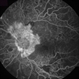 Proliferative Diabetic Retinopathy - Neovascularization on the Disc Proliferative Diabetic Retinopathy - Neovascularization on the Disc