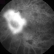 Proliferative Diabetic Retinopathy - Neovascularization on the Disc Proliferative Diabetic Retinopathy - Neovascularization on the Disc