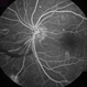 Proliferative Diabetic Retinopathy Proliferative Diabetic Retinopathy