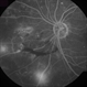 Proliferative Diabetic Retinopathy Proliferative Diabetic Retinopathy